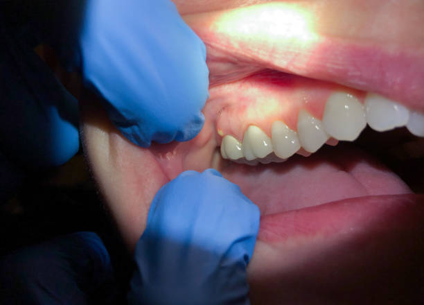 Best Emergency Tooth Extraction  in Polo, IL